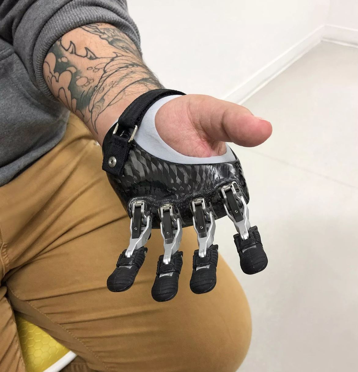 Prosthetics and the Role of OT (11/11/25)